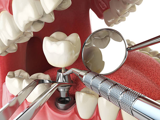 Best Emergency Root Canal Treatment in El Granada, CA